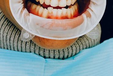 person with dental cheek retractor
